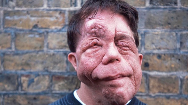 Adam Pearson. Glazer approached him to feature in the film as he was resistant to using prosthetics to show the condition. 